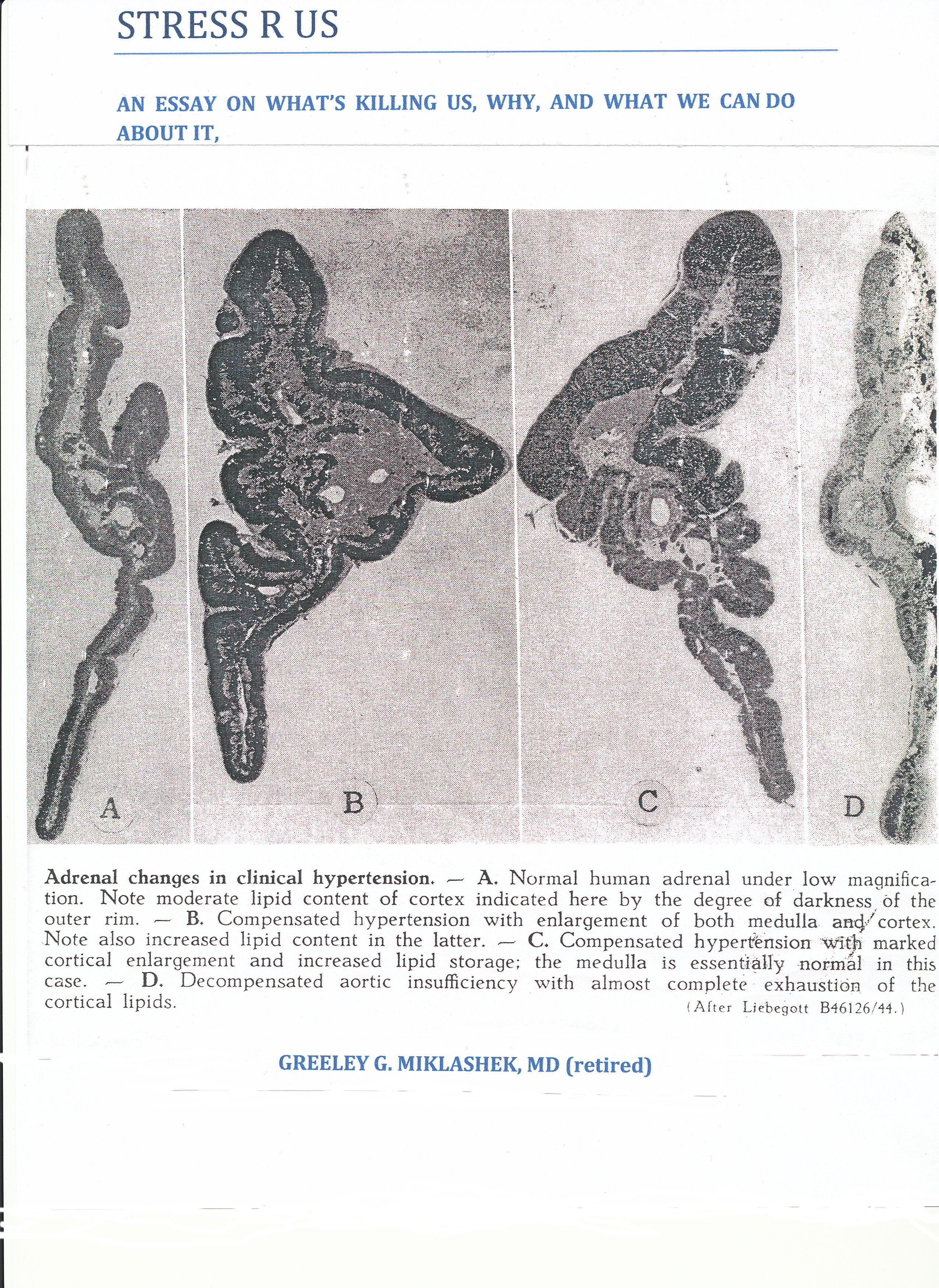 Front cover of "Stress R Us" demonstrating over-active adrenal glands leading to adrenal failure